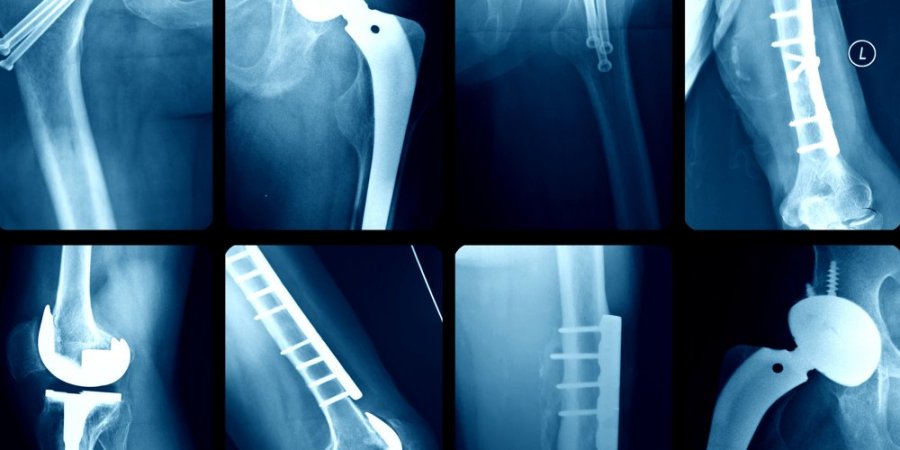 implant-files-scandale-sanitaire-protheses-implants